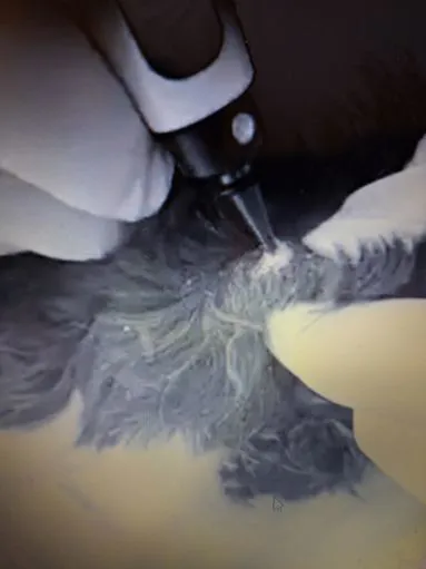Trattamenti di criochirurgia